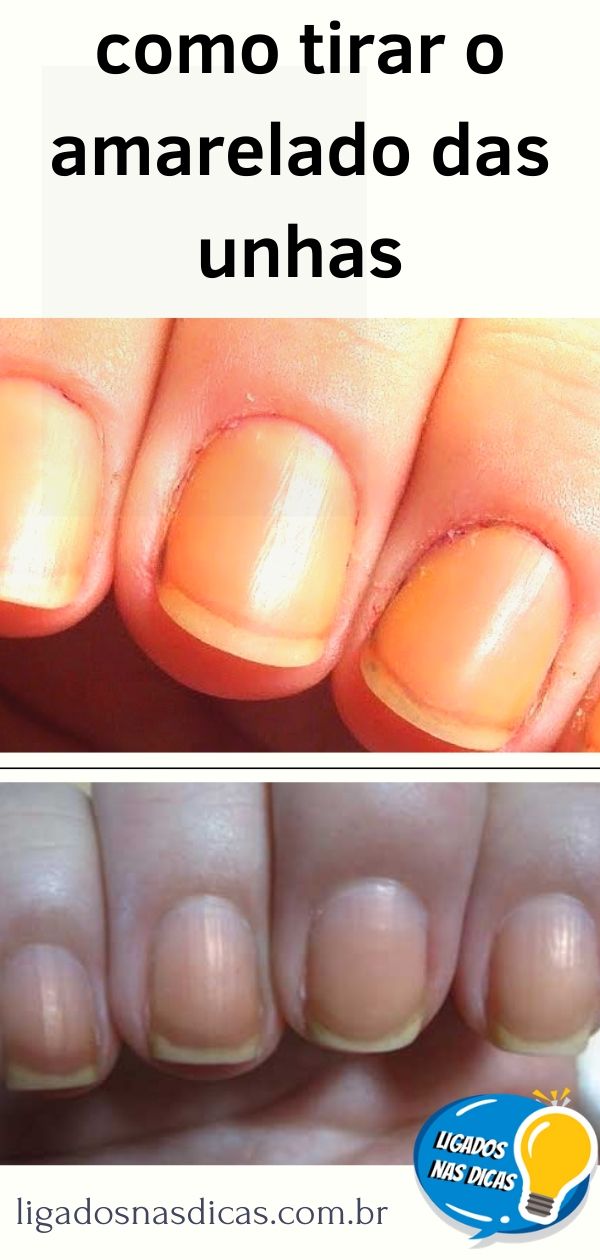 como tirar o amarelado das unhas como tirar o amarelado das unhas