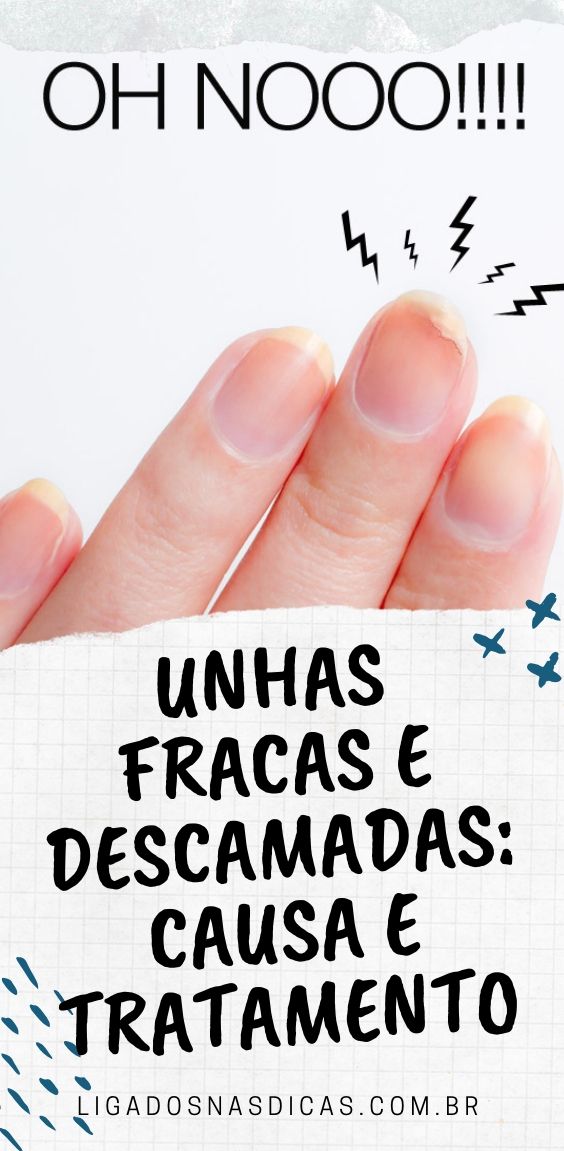 Unhas Fracas e Descamadas Unhas Fracas e Descamadas