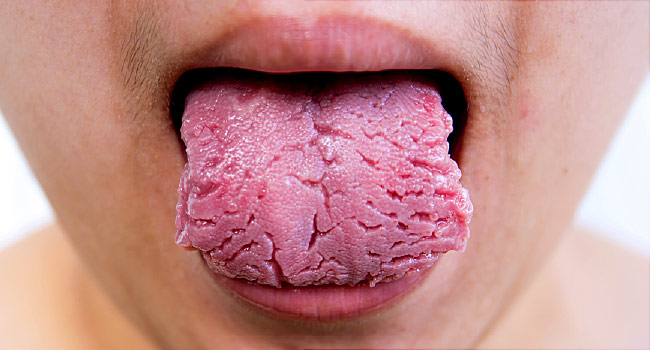 8 sinais que sua língua dá sobre sua saúde 8 sinais que sua lingua da sobre sua saude