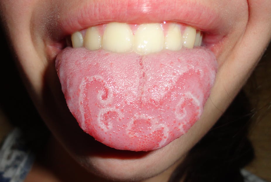 8 sinais que sua língua dá sobre sua saúde