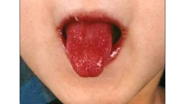 8 sinais que sua língua dá sobre sua saúde