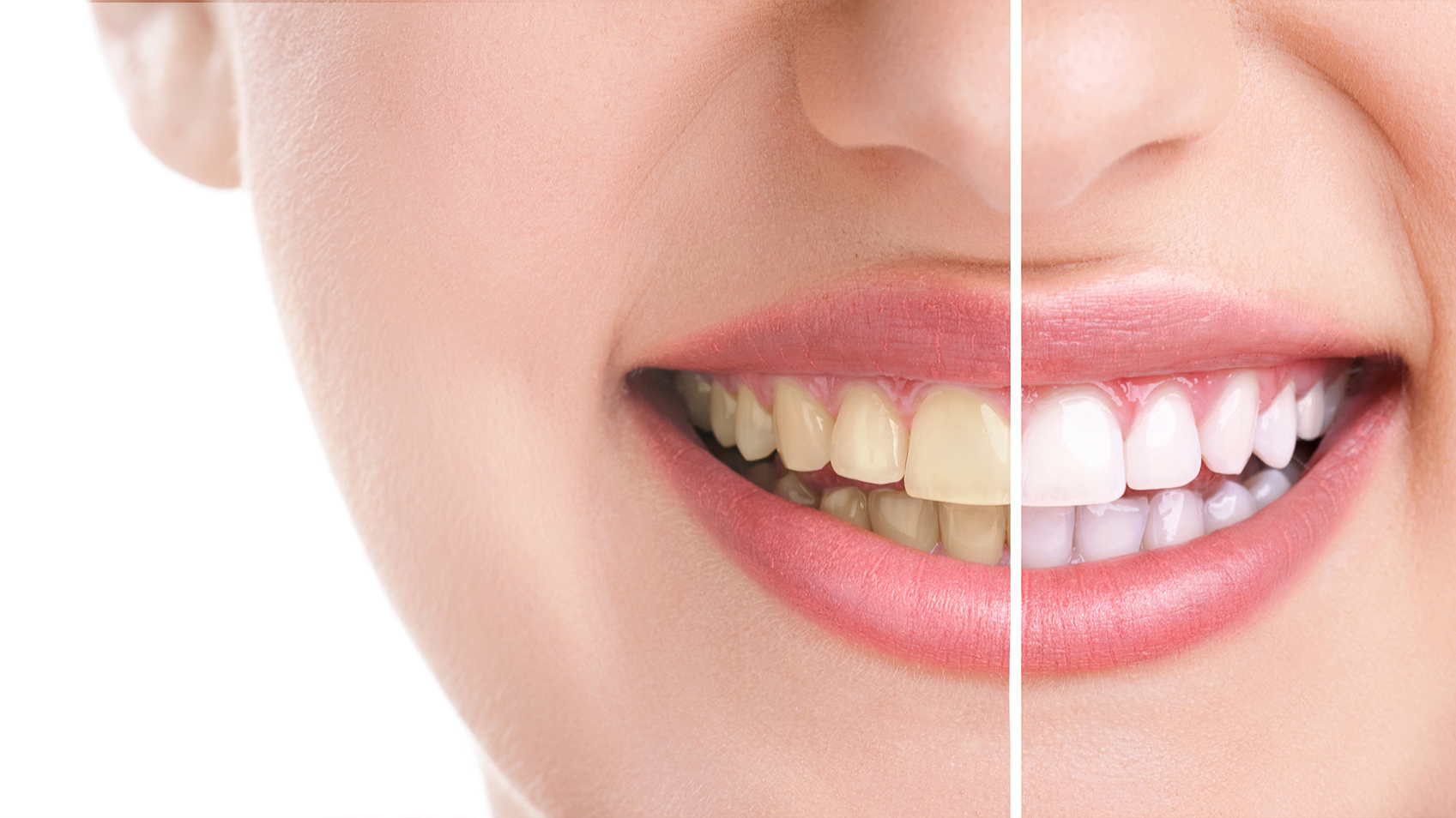 clareamento dental clareamento dental